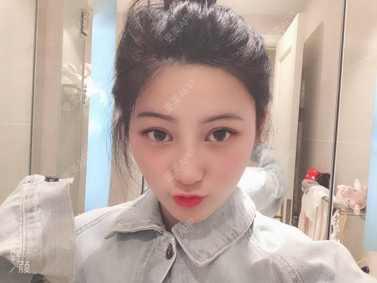 更美 - 软兔є(･◇･｡)э的埋线双眼皮经验 | 埋线双眼皮 | 视频日记 | 武汉