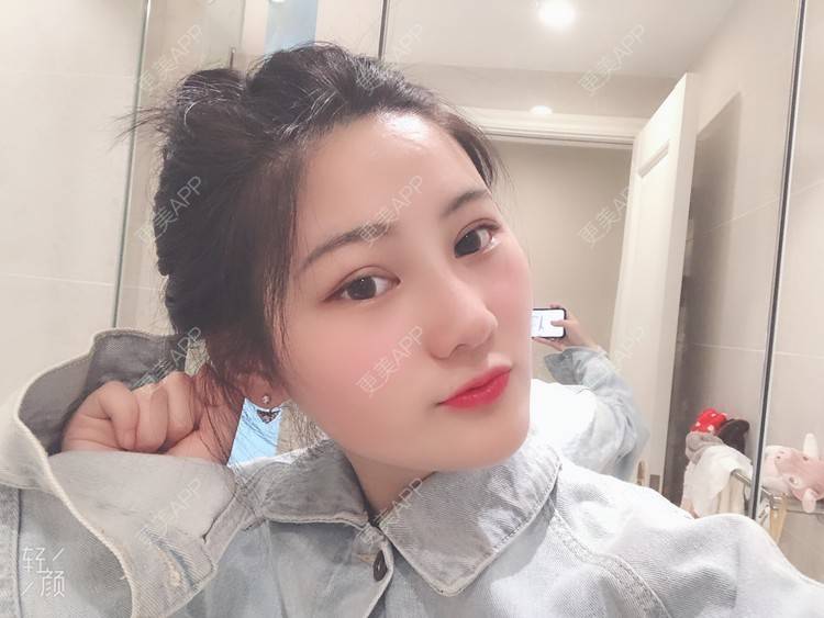 更美 - 软兔є(･◇･｡)э的埋线双眼皮经验 | 埋线双眼皮 | 视频日记 | 武汉
