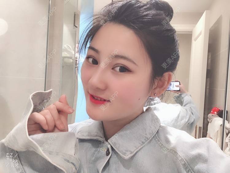更美 - 软兔є(･◇･｡)э的埋线双眼皮经验 | 埋线双眼皮 | 视频日记 | 武汉