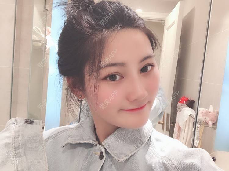 更美 - 软兔є(･◇･｡)э的埋线双眼皮经验 | 埋线双眼皮 | 视频日记 | 武汉