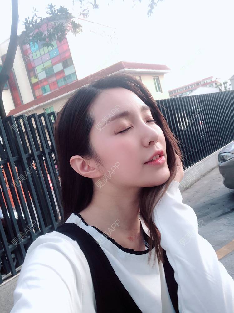 更美 - 更美用户TIxx2z1nYV的埋线双眼皮经验 | 埋线双眼皮 | 郑州