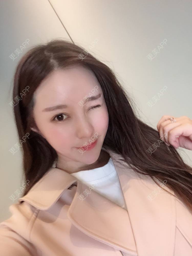 更美 - 更美用户TIxx2z1nYV的埋线双眼皮经验 | 埋线双眼皮 | 郑州