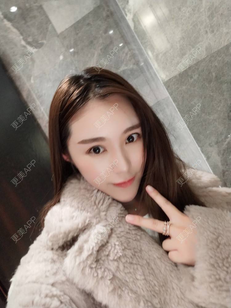 更美 - 更美用户TIxx2z1nYV的埋线双眼皮经验 | 埋线双眼皮 | 郑州