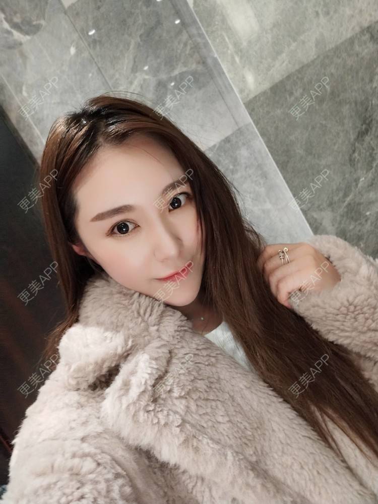 更美 - 更美用户TIxx2z1nYV的埋线双眼皮经验 | 埋线双眼皮 | 郑州