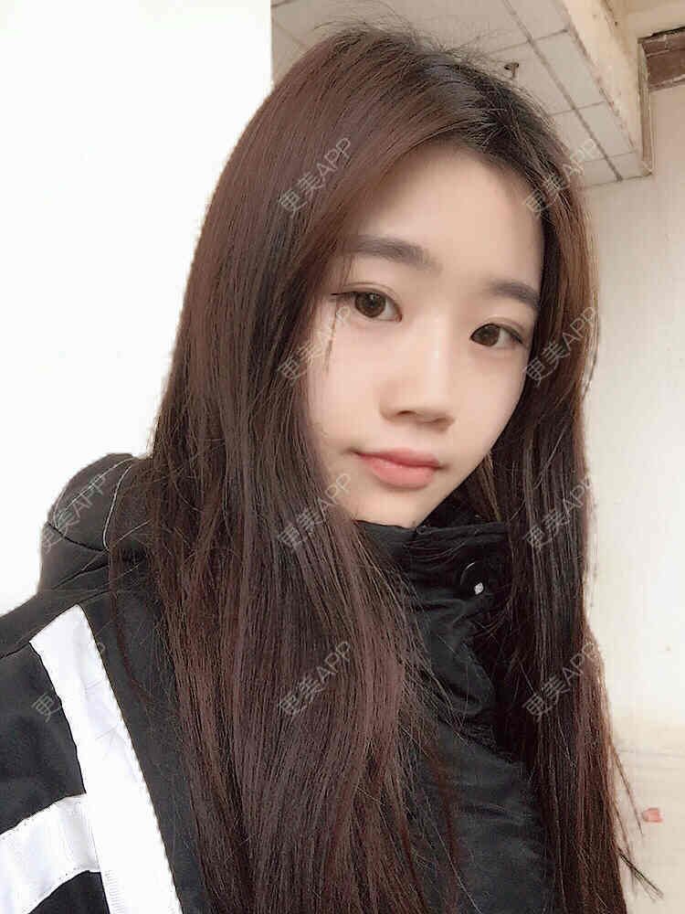 更美 - 。╃颓喃尐女渭的颧弓降低经验 | 颧弓降低 | 武汉