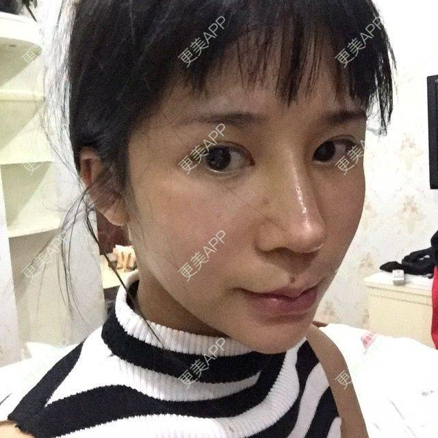 更美 - 更美用户DyTX1fg9DK的歪鼻矫正经验 | 歪鼻矫正 | 郑州
