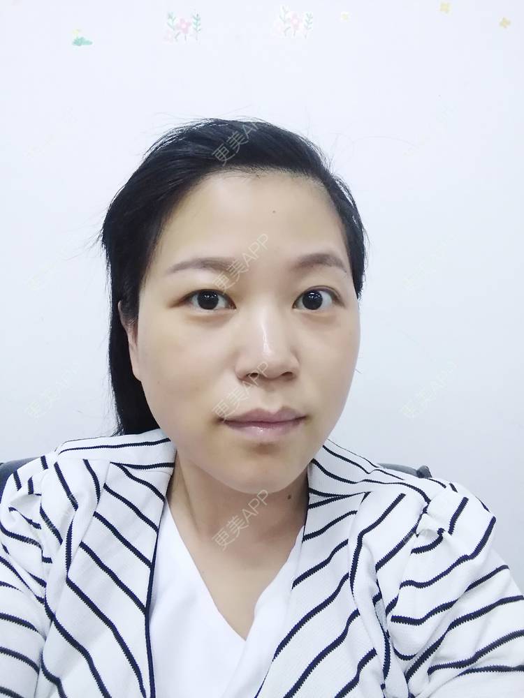 更美 - 更美用户1DnFWuIju7的埋线提升经验 | 埋线提升 | 埋线除皱