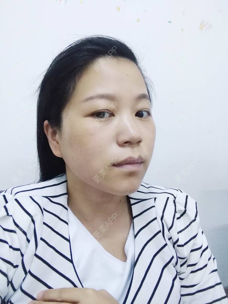 更美 - 更美用户1DnFWuIju7的埋线提升经验 | 埋线提升 | 埋线除皱