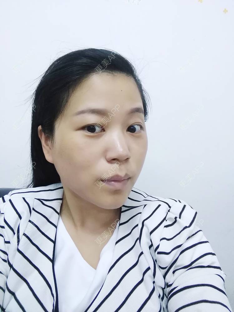 更美 - 更美用户1DnFWuIju7的埋线提升经验 | 埋线提升 | 埋线除皱