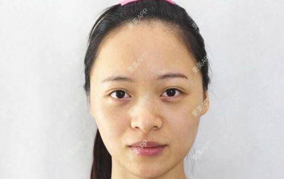 更美 - 更美用户C587QffcEA的歪鼻矫正经验 | 歪鼻矫正 | 郑州