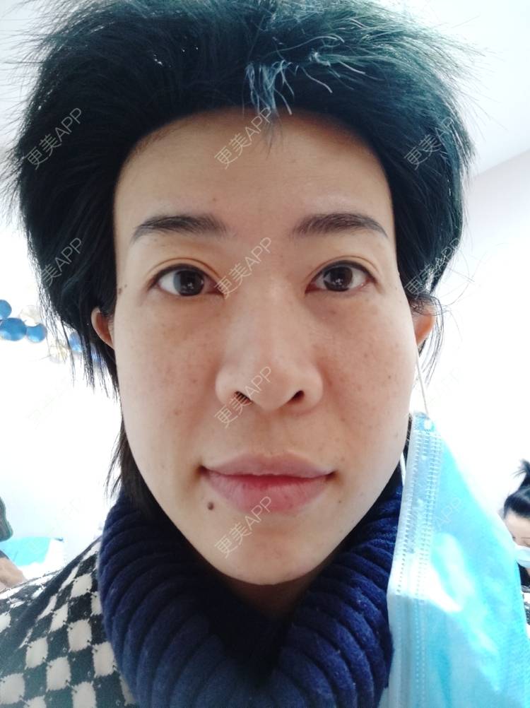 更美 - 王笑笑笑一个的玻尿酸导入经验 | 小气泡 | 玻尿酸导入 | 淄博