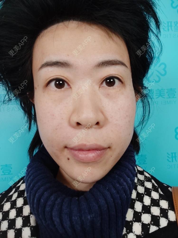更美 - 王笑笑笑一个的玻尿酸导入经验 | 小气泡 | 玻尿酸导入 | 淄博