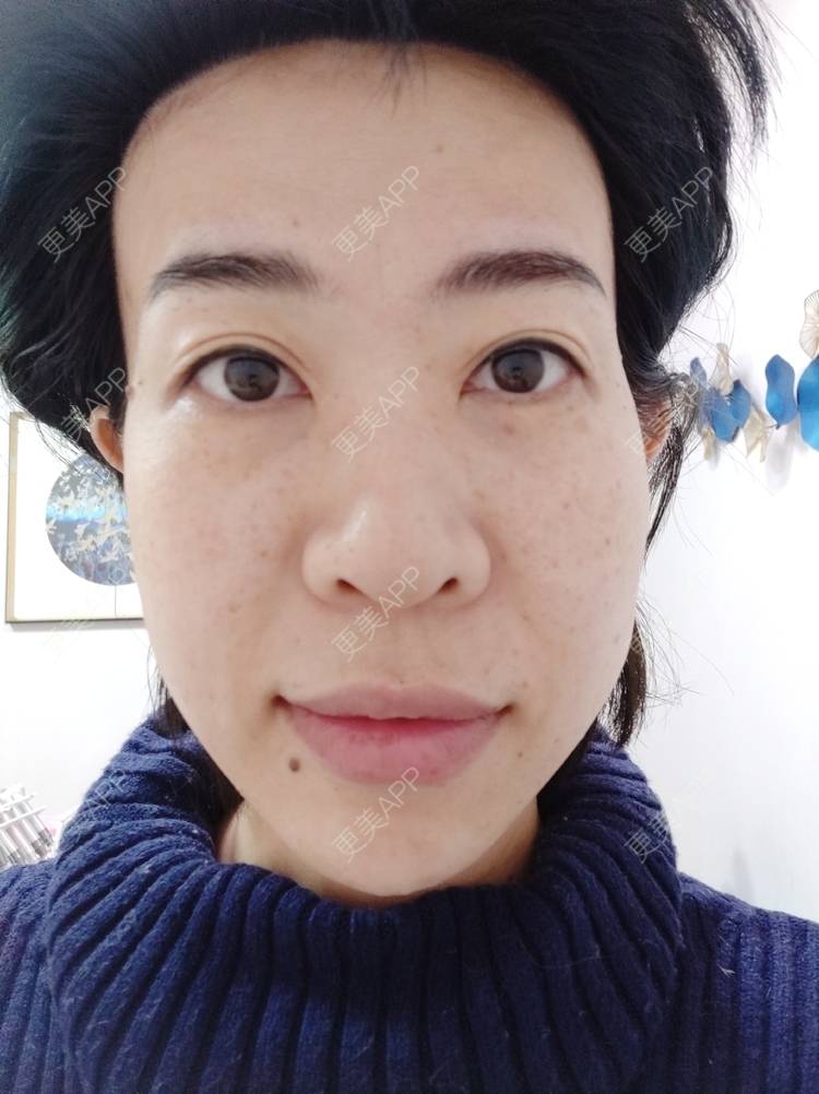 更美 - 王笑笑笑一个的玻尿酸导入经验 | 小气泡 | 玻尿酸导入 | 淄博