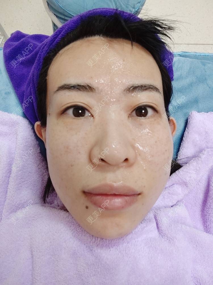 更美 - 王笑笑笑一个的玻尿酸导入经验 | 小气泡 | 玻尿酸导入 | 淄博