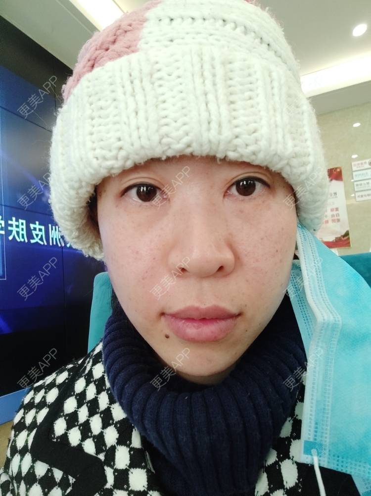 更美 - 王笑笑笑一个的玻尿酸导入经验 | 小气泡 | 玻尿酸导入 | 淄博