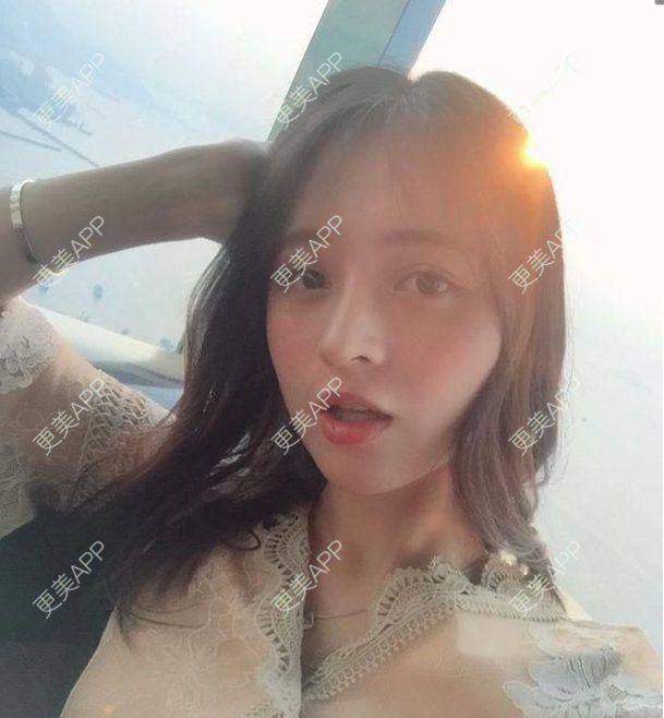 更美 - 更美用户C587QffcEA的歪鼻矫正经验 | 歪鼻矫正 | 郑州