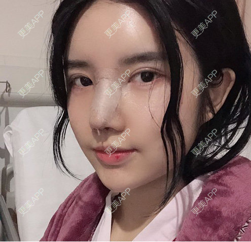 更美 - 更美用户RiI5ZcfMlI的歪鼻矫正经验 | 歪鼻矫正 | 郑州