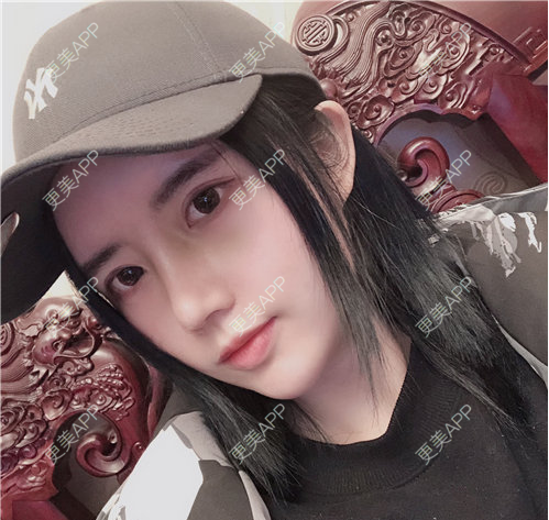 更美 - 更美用户RiI5ZcfMlI的歪鼻矫正经验 | 歪鼻矫正 | 郑州