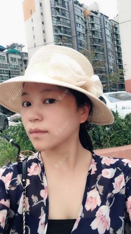 更美 - 更美用户1DnFWuIju7的埋线提升经验 | 埋线提升 | 视频日记 | 埋线除皱