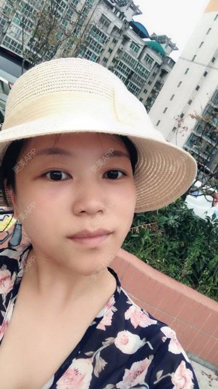 更美 - 更美用户1DnFWuIju7的埋线提升经验 | 埋线提升 | 视频日记 | 埋线除皱