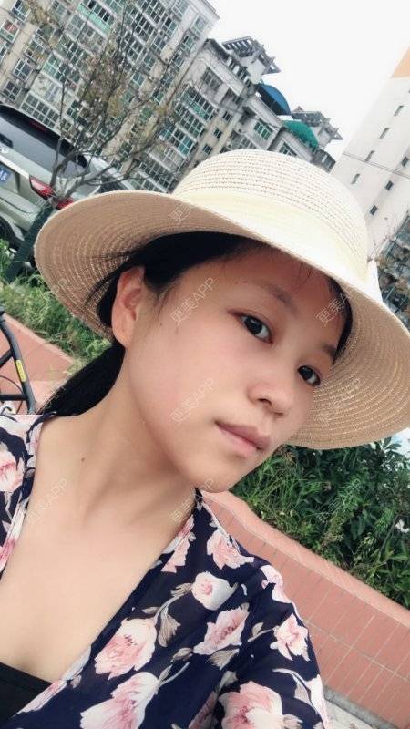 更美 - 更美用户1DnFWuIju7的埋线提升经验 | 埋线提升 | 视频日记 | 埋线除皱