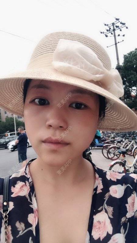 更美 - 更美用户1DnFWuIju7的埋线提升经验 | 埋线提升 | 视频日记 | 埋线除皱