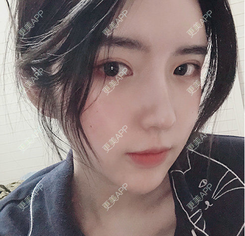 更美 - 更美用户RiI5ZcfMlI的歪鼻矫正经验 | 歪鼻矫正 | 郑州