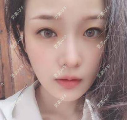 更美 - 更美用户RiI5ZcfMlI的歪鼻矫正经验 | 歪鼻矫正 | 郑州