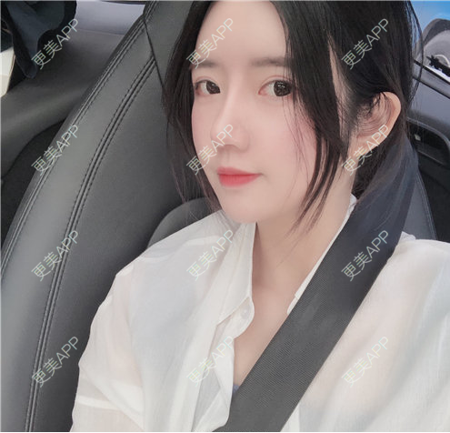 更美 - 更美用户RiI5ZcfMlI的歪鼻矫正经验 | 歪鼻矫正 | 郑州