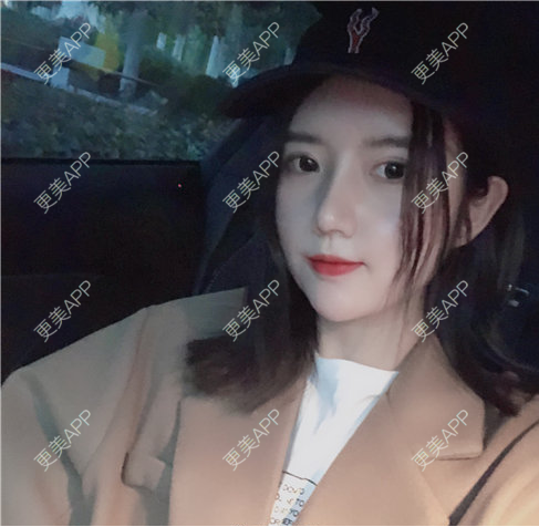 更美 - 更美用户RiI5ZcfMlI的歪鼻矫正经验 | 歪鼻矫正 | 郑州