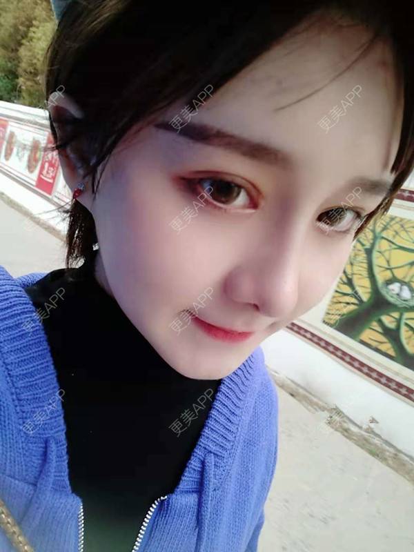 更美 - 小白白丫的埋线除皱经验 | 北京 | 视频日记 | 埋线除皱