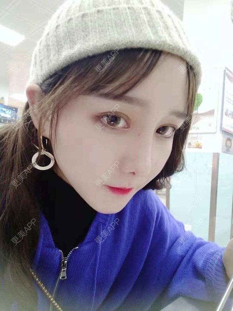 更美 - 小白白丫的埋线除皱经验 | 北京 | 视频日记 | 埋线除皱