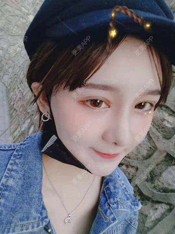 更美 - 小白白丫的埋线除皱经验 | 北京 | 视频日记 | 埋线除皱