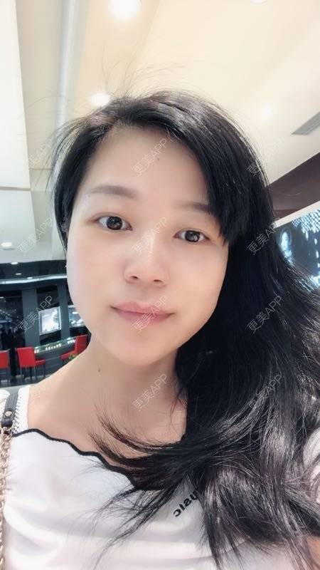 更美 - 更美用户1DnFWuIju7的埋线提升经验 | 埋线提升 | 视频日记 | 埋线除皱