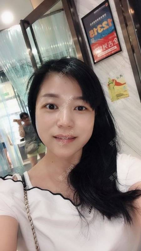 更美 - 更美用户1DnFWuIju7的埋线提升经验 | 埋线提升 | 视频日记 | 埋线除皱
