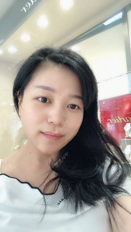 更美 - 更美用户1DnFWuIju7的埋线提升经验 | 埋线提升 | 视频日记 | 埋线除皱