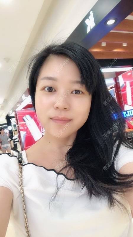 更美 - 更美用户1DnFWuIju7的埋线提升经验 | 埋线提升 | 视频日记 | 埋线除皱