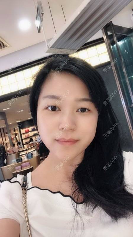 更美 - 更美用户1DnFWuIju7的埋线提升经验 | 埋线提升 | 视频日记 | 埋线除皱