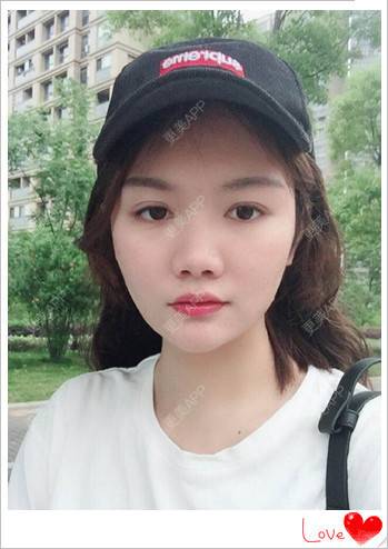 更美 - 简单de幸福！！的玻尿酸鼻部经验 | 玻尿酸鼻部 | 南昌