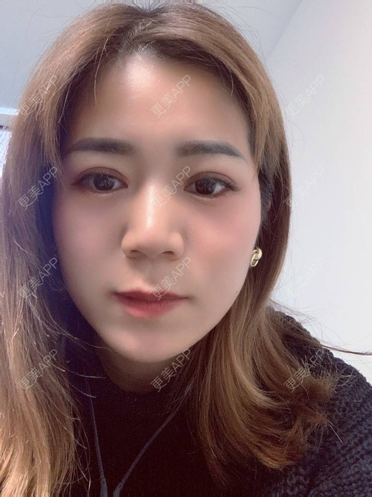更美 - 更美用户B6Dwb08pzE的眼综合修复经验 | 眼综合修复 | 眼部综合