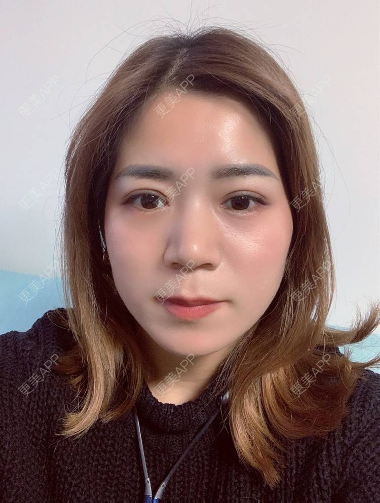 更美 - 更美用户B6Dwb08pzE的眼综合修复经验 | 眼综合修复 | 眼部综合