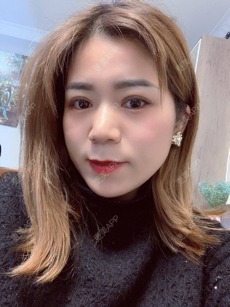 更美 - 更美用户B6Dwb08pzE的眼综合修复经验 | 眼综合修复 | 眼部综合
