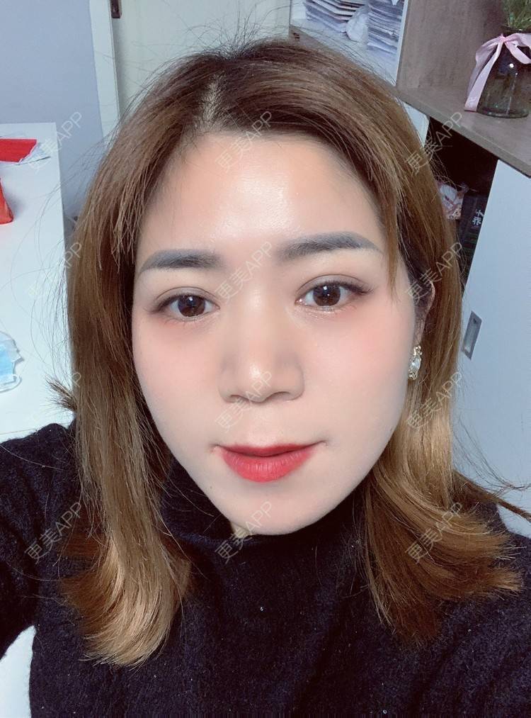 更美 - 更美用户B6Dwb08pzE的眼综合修复经验 | 眼综合修复 | 眼部综合