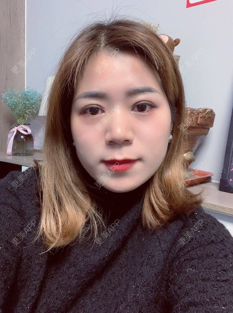 更美 - 更美用户B6Dwb08pzE的眼综合修复经验 | 眼综合修复 | 眼部综合