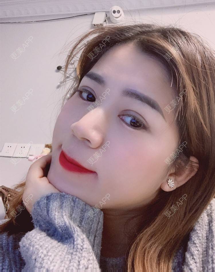 更美 - 更美用户B6Dwb08pzE的眼综合修复经验 | 眼综合修复 | 眼部综合