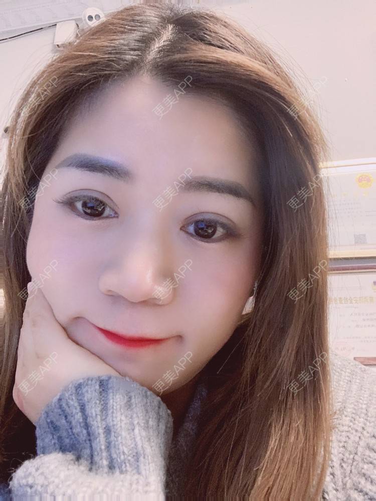 更美 - 更美用户B6Dwb08pzE的眼综合修复经验 | 眼综合修复 | 眼部综合