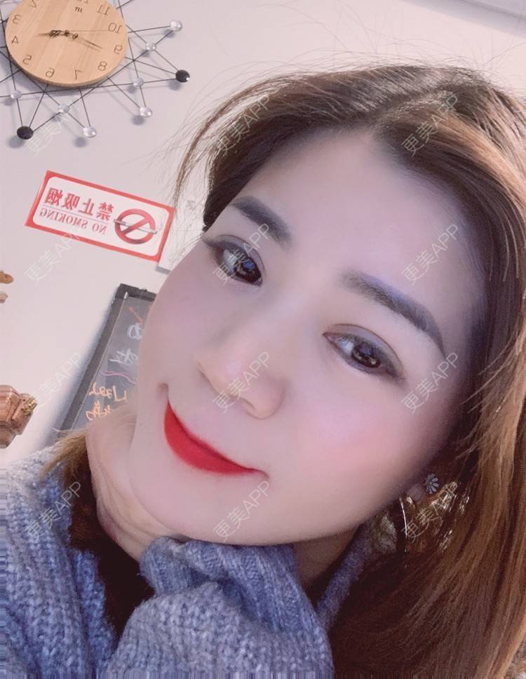更美 - 更美用户B6Dwb08pzE的眼综合修复经验 | 眼综合修复 | 眼部综合