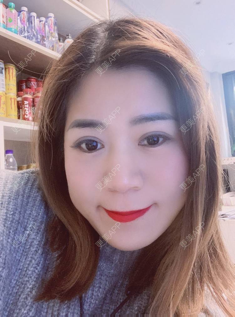 更美 - 更美用户B6Dwb08pzE的眼综合修复经验 | 眼综合修复 | 眼部综合