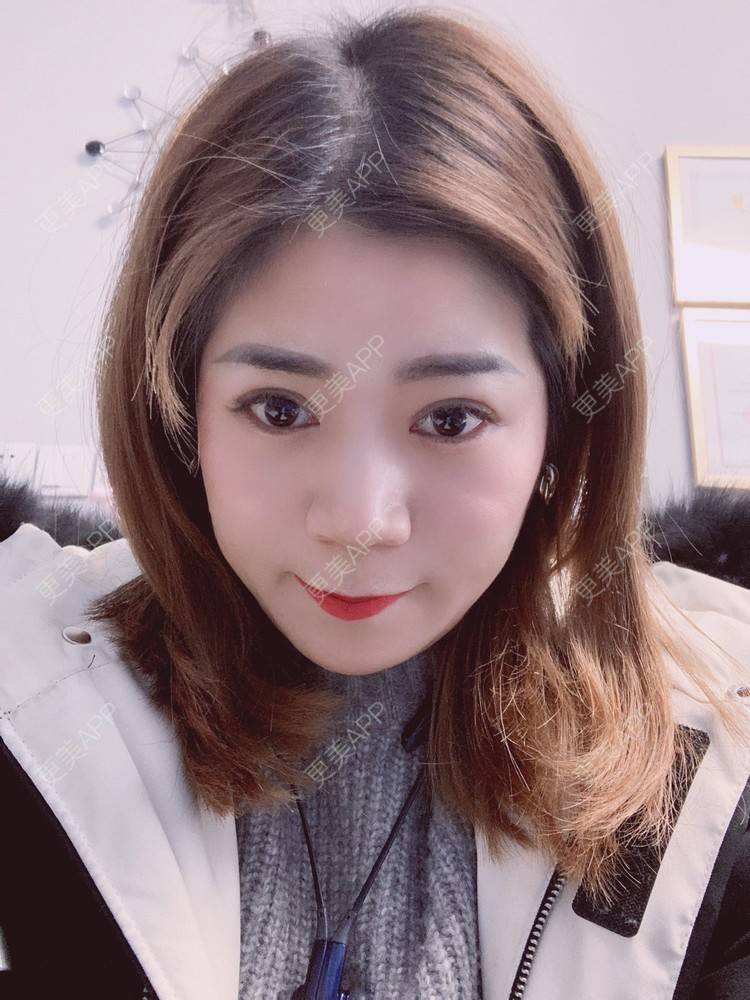 更美 - 更美用户B6Dwb08pzE的眼综合修复经验 | 眼综合修复 | 眼部综合