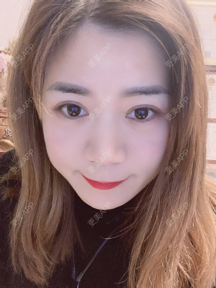 更美 - 更美用户B6Dwb08pzE的眼综合修复经验 | 眼综合修复 | 眼部综合